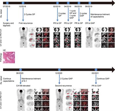 Long-Term Response to Gemcitabine, Cisplatin, and Nab-Paclitaxel Followed by Maintenance Therapy for Advanced Gallbladder Cancer: A Case Report and Literature Review